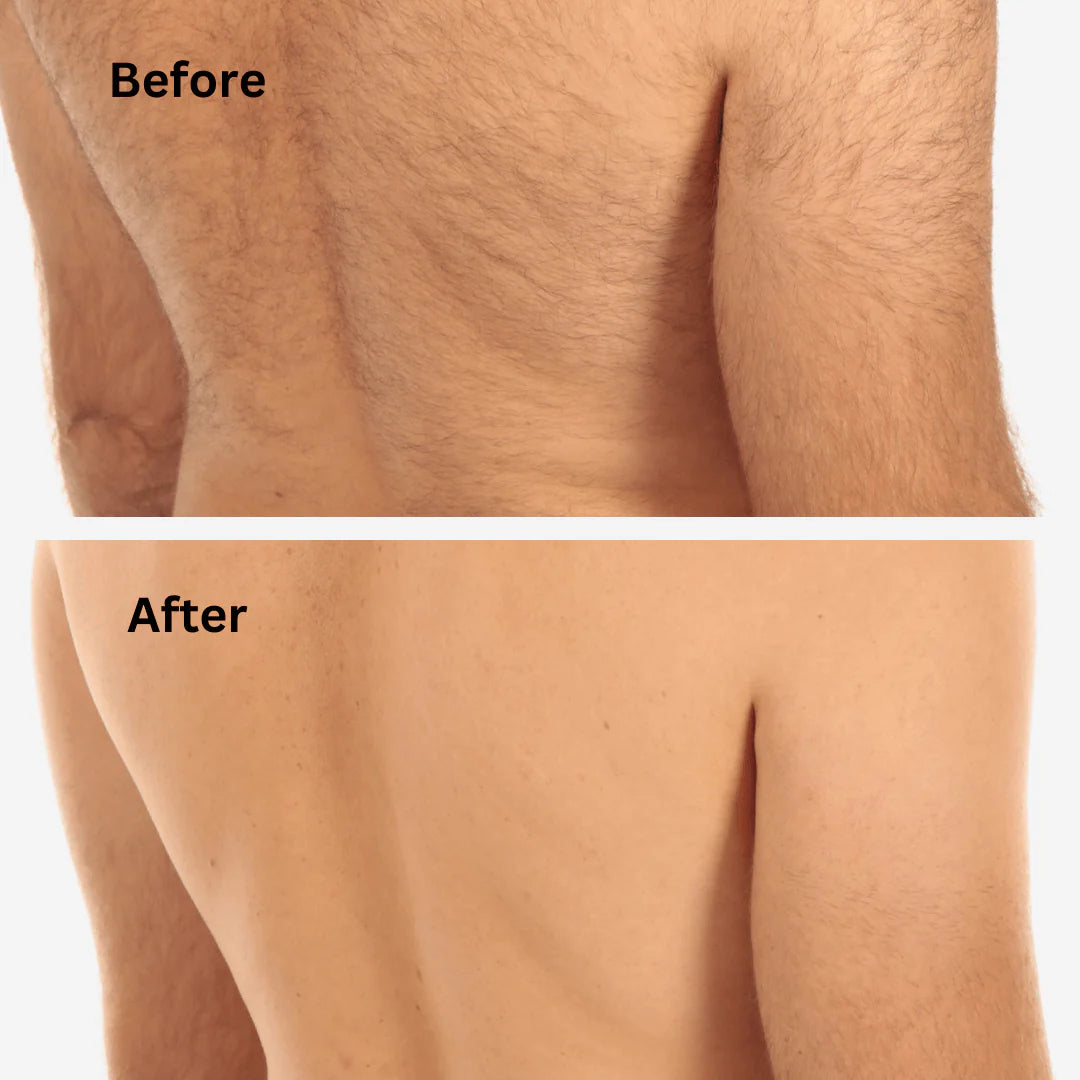 Sensilight Pro At-Home Hair Removal