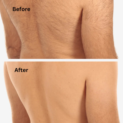 Sensilight Pro At-Home Hair Removal
