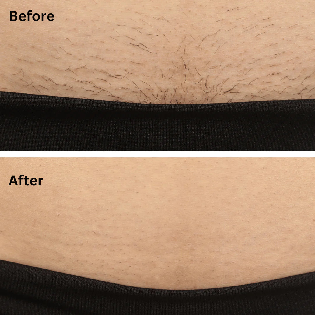 Sensilight Pro At-Home Hair Removal