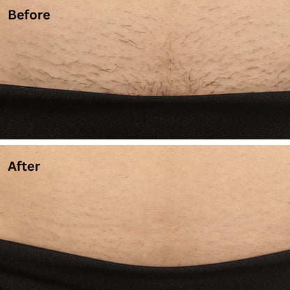 Sensilight Pro At-Home Hair Removal